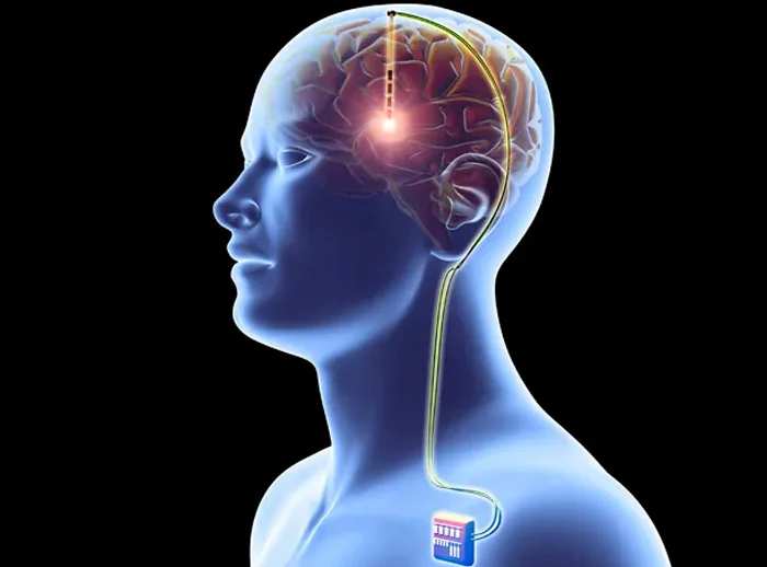 Deep Brain Stimulation(DBS)